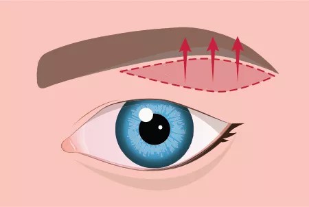 Oberlidstraffung Schritt 2