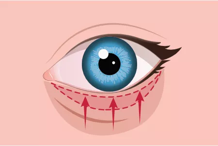 Unterlidstraffung Schritt 2